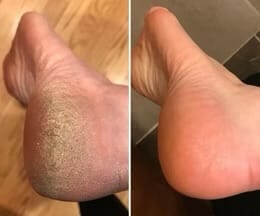 Customer photo review of Podovia™ – Stick Réparateur Pieds Secs & Talons Fissurés