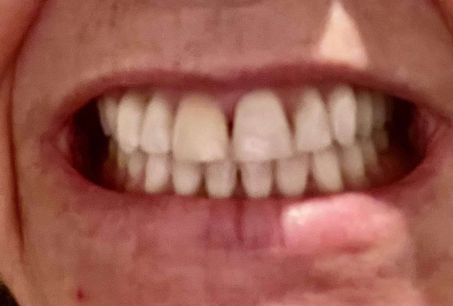 Customer photo review of Pack Bandes Originales : 2 Paquets Bandes Kauka Smile (sans peroxyde)