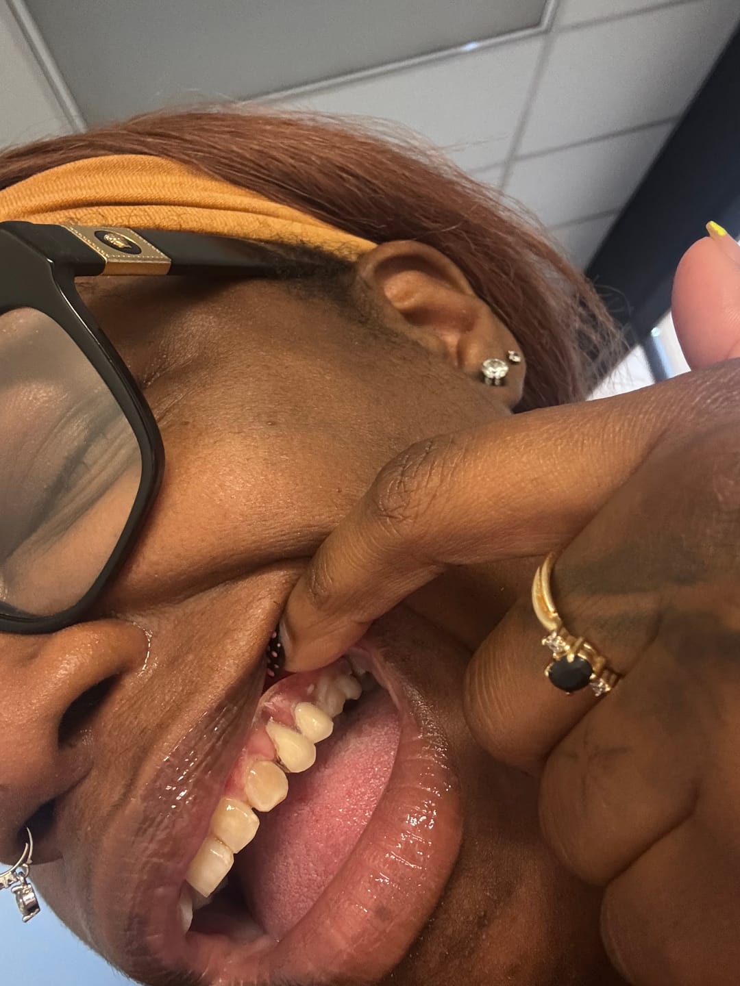 Customer photo review of Clear Unilateral Partial Denture