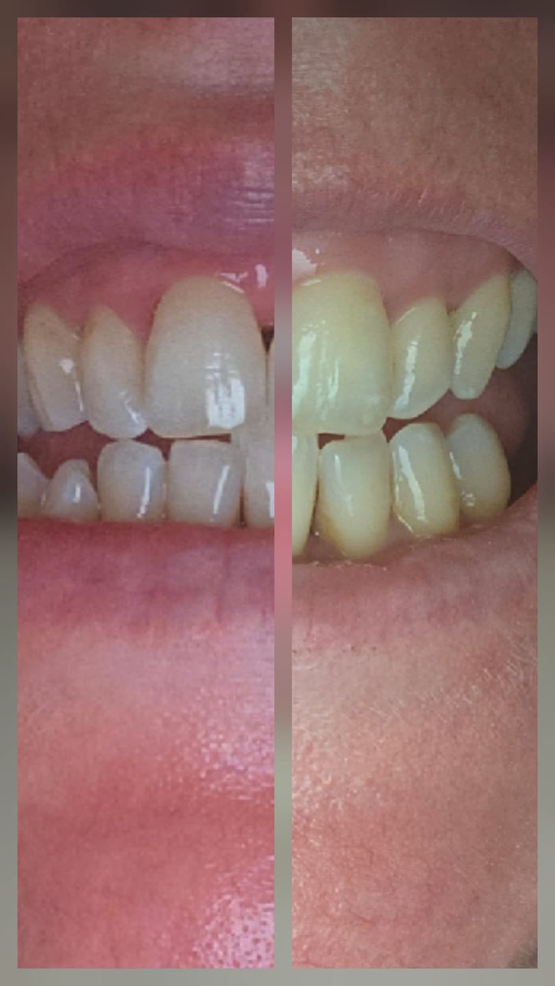 Customer photo review of 14 Day Smile Transformation Kit