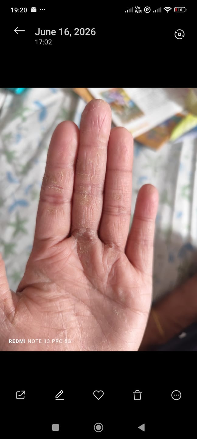 Customer photo review of Bioskin Junior Outbreak Rescue Cream