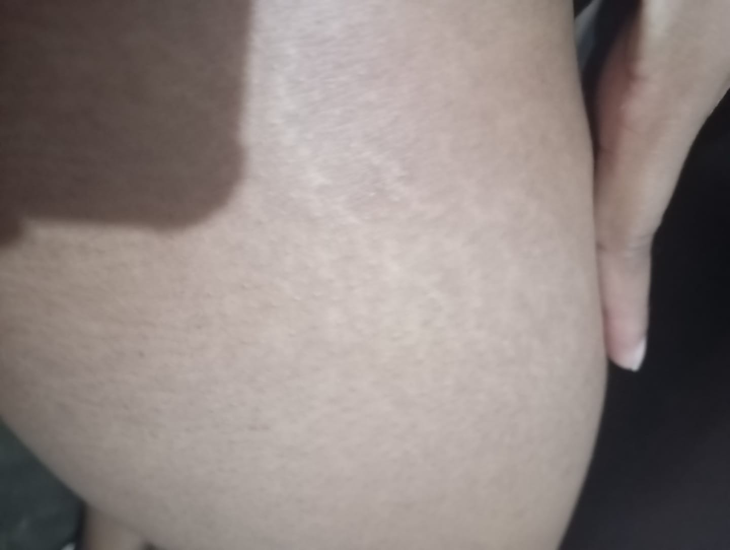 Customer photo review of Creme Antiestrias Regenerador Dérmico