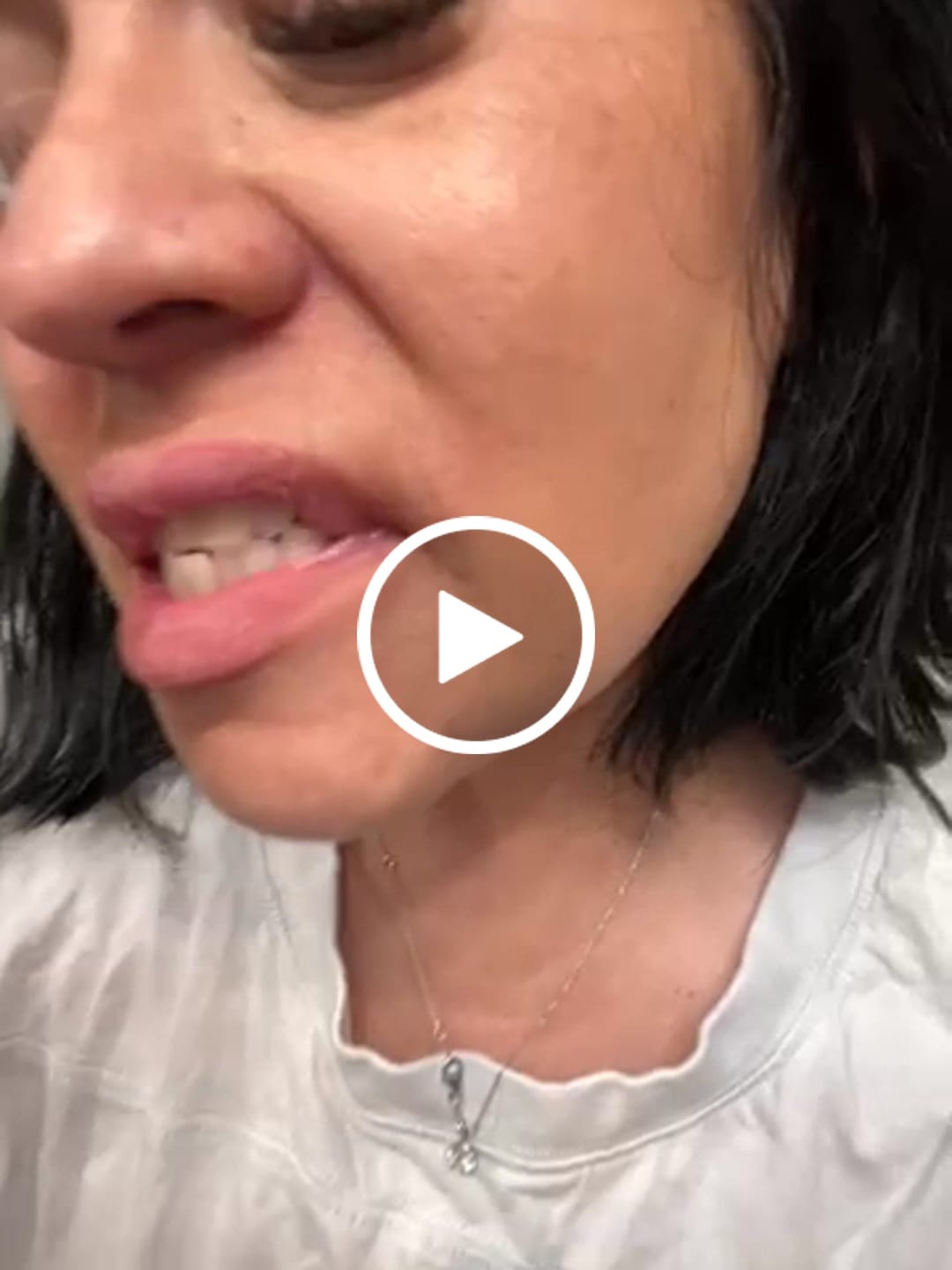 Customer video review of Unilateral Partial Denture