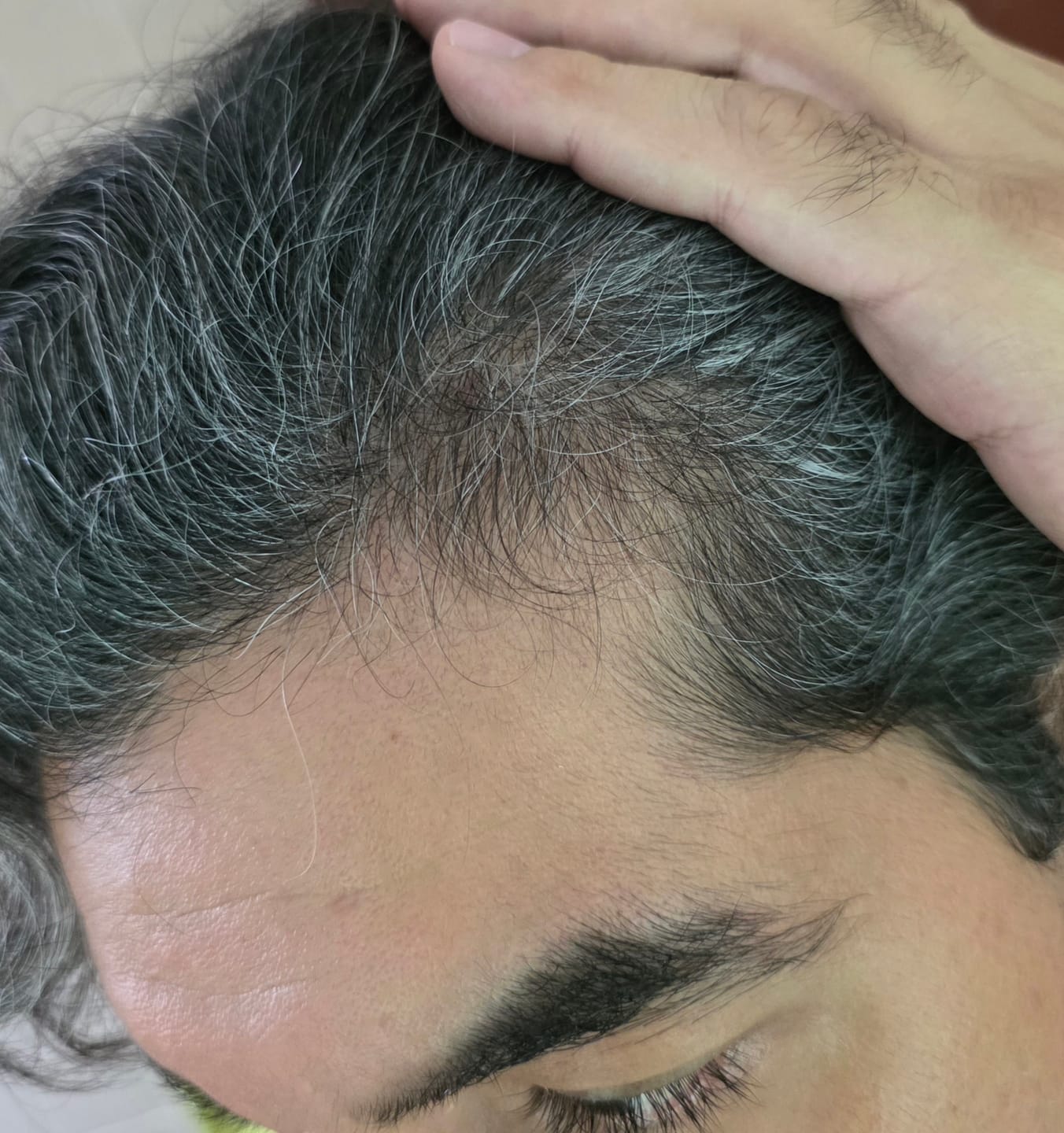 Customer photo review of Minoxidil 5 mg con 90 tabletas para 3 meses de tratamiento