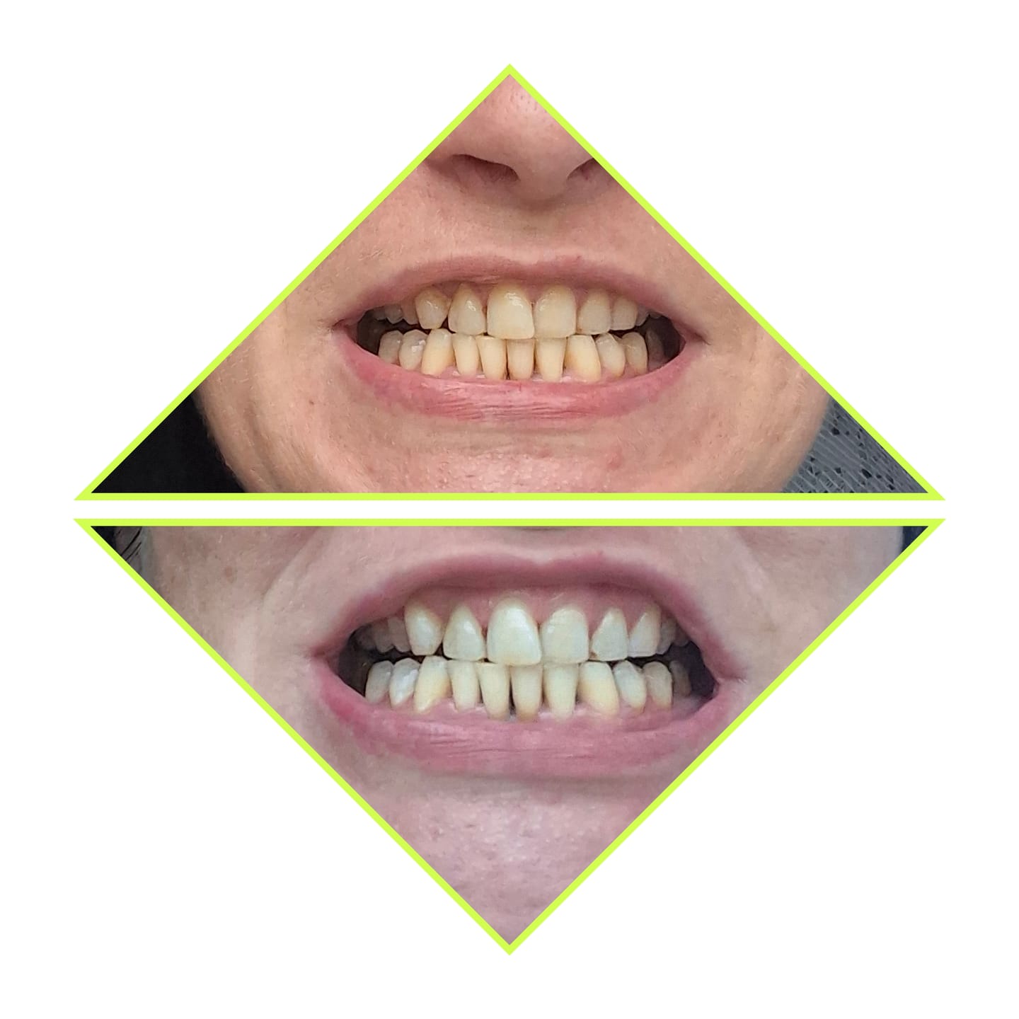 Customer photo review of V24 Violetinės Dantų Balinimo Juostelės