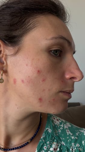 Reviewer's profile view showing skin imperfections on cheek before using Pure Glow supplements.