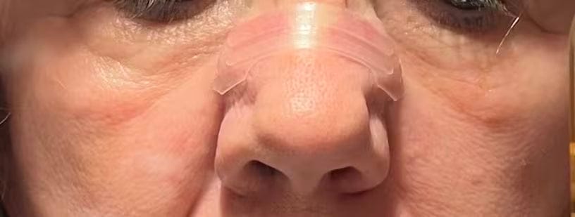 Customer photo review of Nasenpflaster transparent: unauffällig für den Alltag
