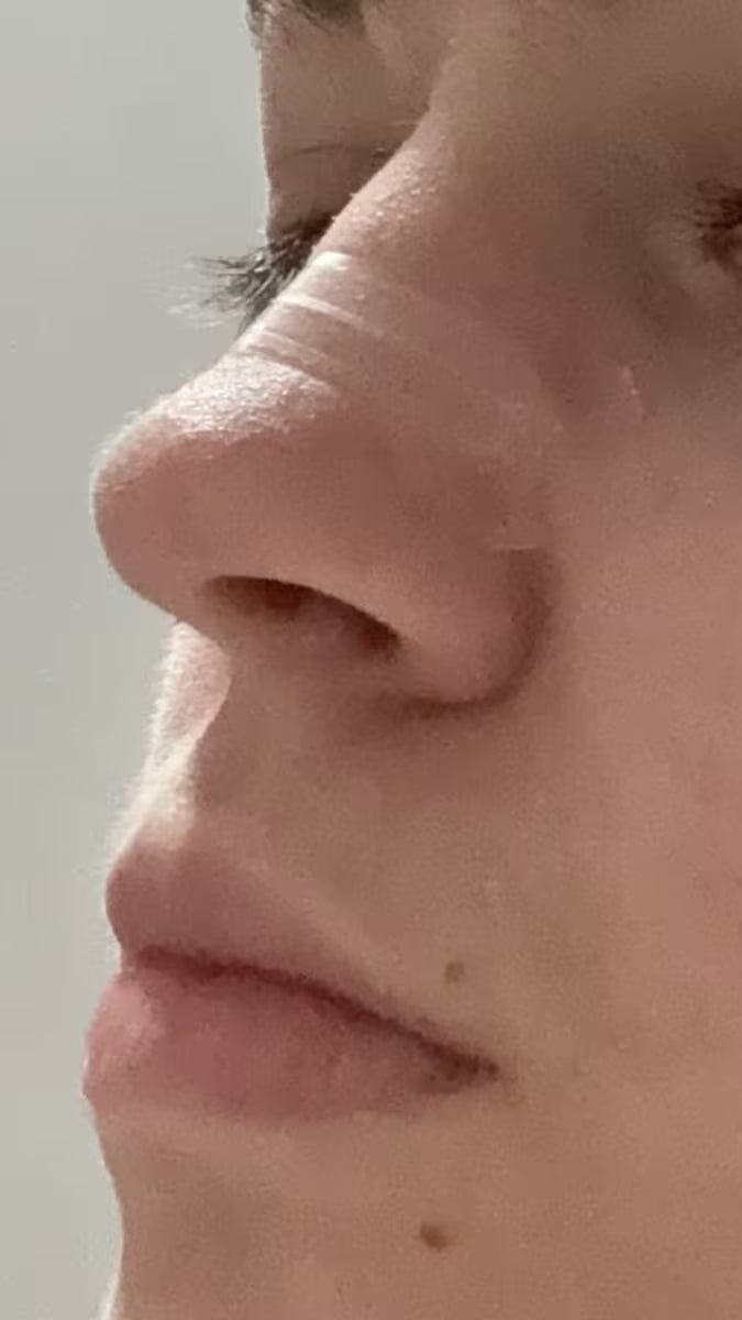 Customer photo review of Nasenpflaster transparent: unauffällig für den Alltag