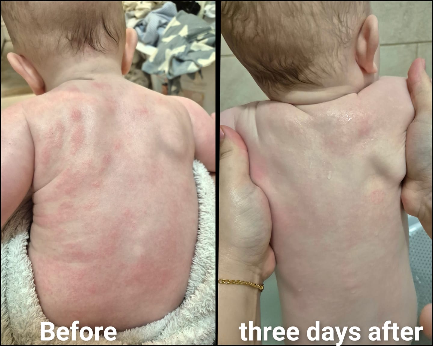 Customer photo review of Bioskin Junior Outbreak Rescue Cream