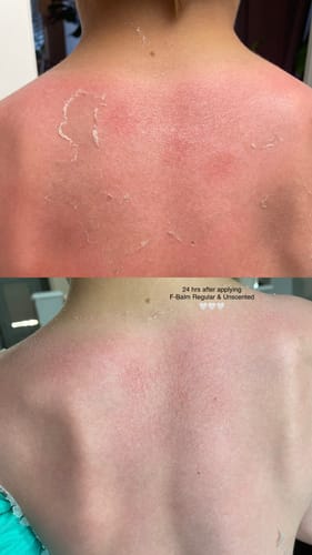 Customer's before-and-after of a sunburned back. The top image shows red peeling skin; the bottom shows soothed skin after using F-Balm.