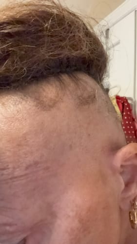 Close-up of a reviewer's temple, showing new hair growth in a thinning area after using the Scalp Stimulator.