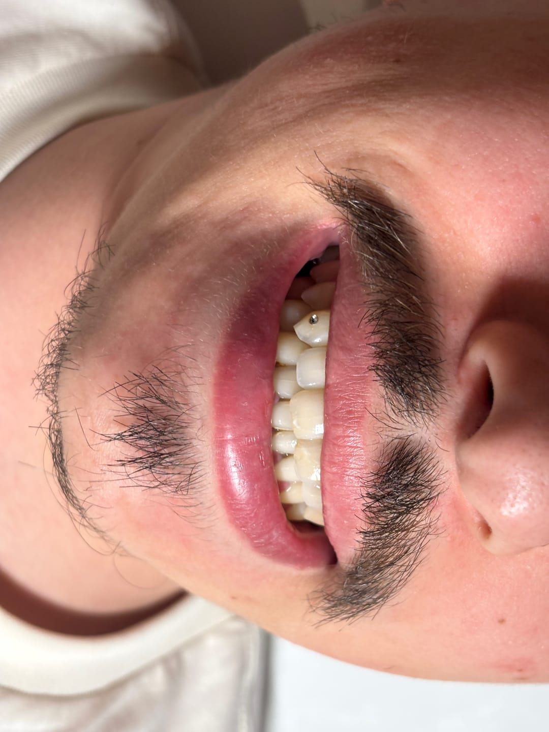 Customer photo review of Pack de adhesivos dentales