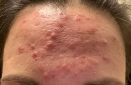 Close-up of a reviewer's forehead showing red, bumpy skin before using the Radiating Cream.