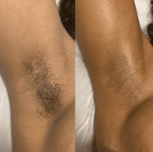 Customer photo review of Renovia™ Cyperus Rotundus Skin Serum | Stop Unwanted Hair Growth Naturally