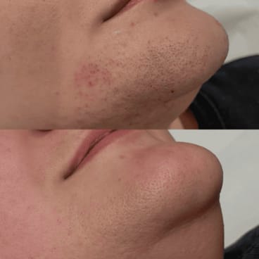 Customer photo review of Renovia™ Cyperus Rotundus Skin Serum | Stop Unwanted Hair Growth Naturally