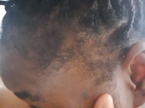 Customer photo review of Minoxidil High Strength (5%) SOLUTION, 3x60ml pack