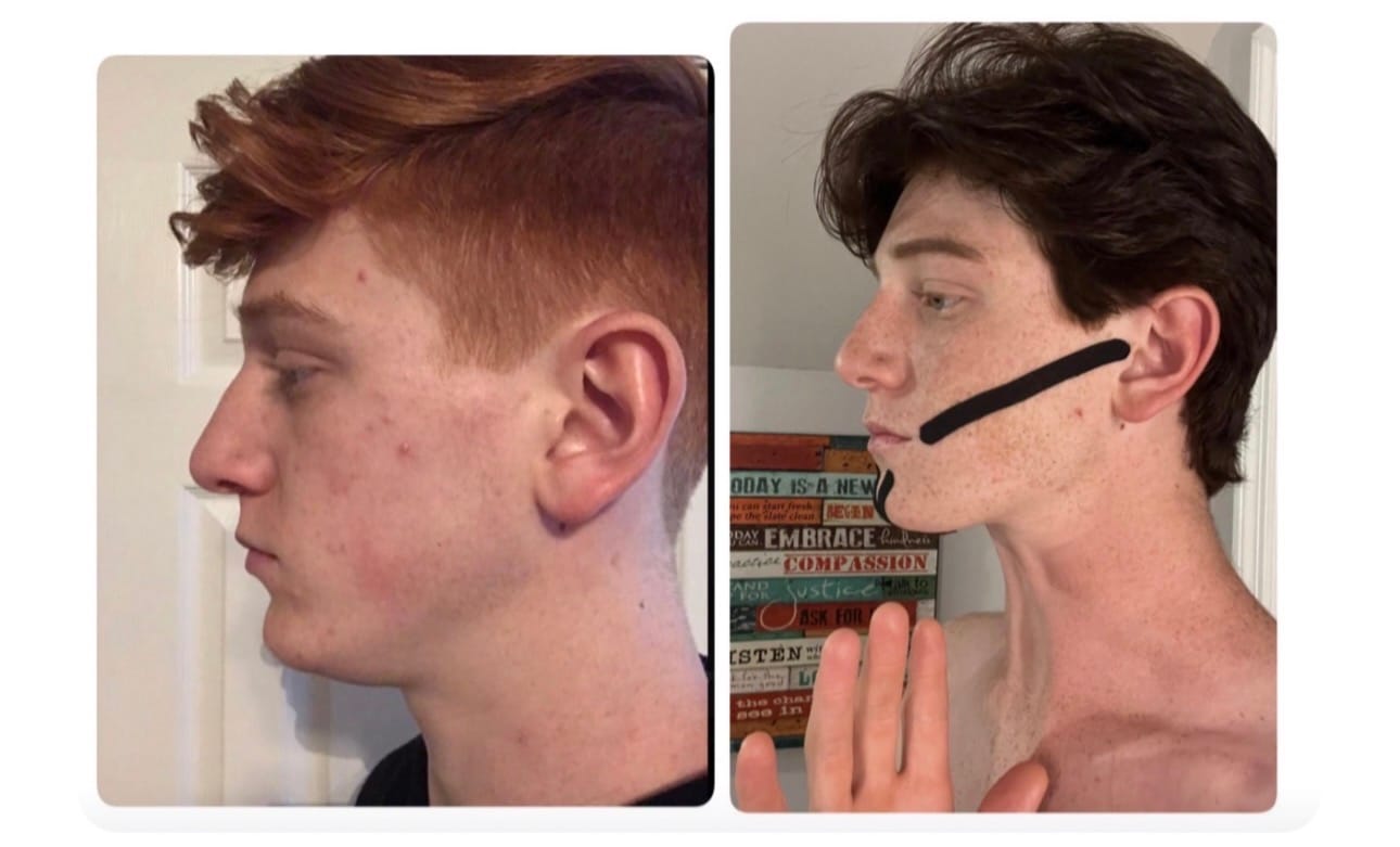 Customer photo review of Revive Your Beauty - Zygomatic Tape for Facial Sculpting & Anti-Aging
