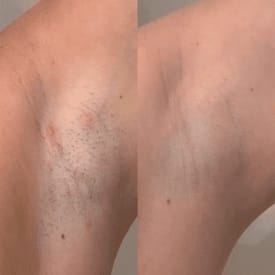 Customer photo review of Renovia™ Cyperus Rotundus Skin Serum | Stop Unwanted Hair Growth Naturally