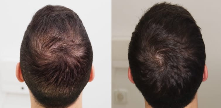 Customer photo review of Sérum Anticaída de Doble Acción | Hair Biolabs™