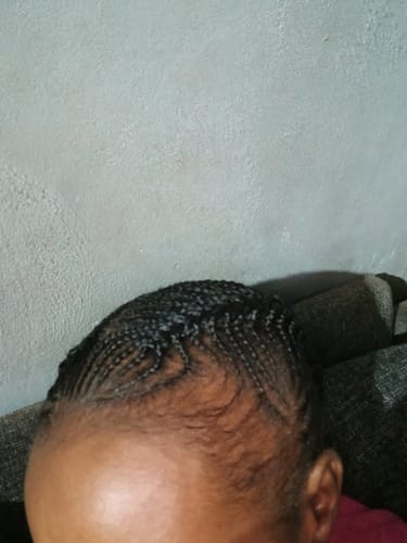 Customer photo review of Minoxidil 5% Solution, 1 Pack 60ml