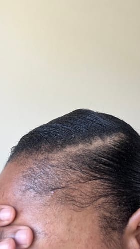 Customer photo review of Minoxidil High Strength (5%) SOLUTION, 3x60ml pack