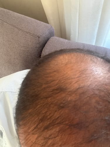 Customer photo review of Minoxidil REGULAR (2%) strength SOLUTION, 3x60ml pack