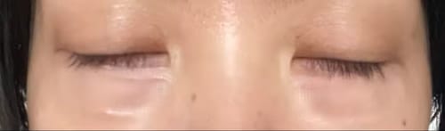 Customer photo review of Microneedle Patches by LYONZA