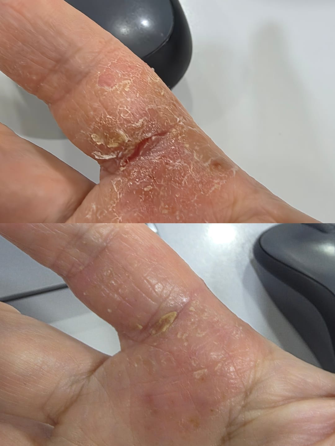 Customer photo review of RCV PRO – Barrier Repair for Eczema, Psoriasis and Sensitive skin