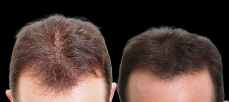 Customer photo review of Sérum Anticaída de Doble Acción | Hair Biolabs™