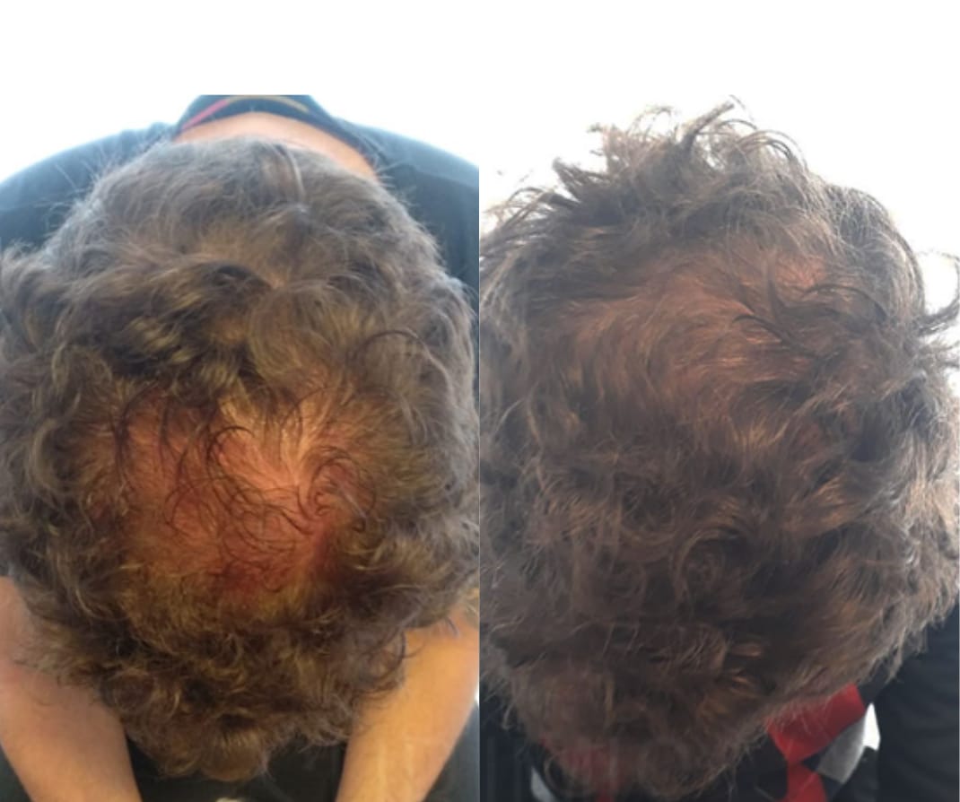 Customer photo review of Sérum Anticaída de Doble Acción | Hair Biolabs™