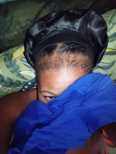 Customer photo review of Minoxidil 5% Solution, 1 Pack 60ml