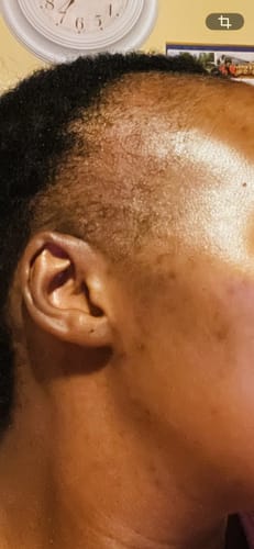 Customer photo review of Minoxidil REGULAR (2%) strength FOAM, 3x60ml Pack