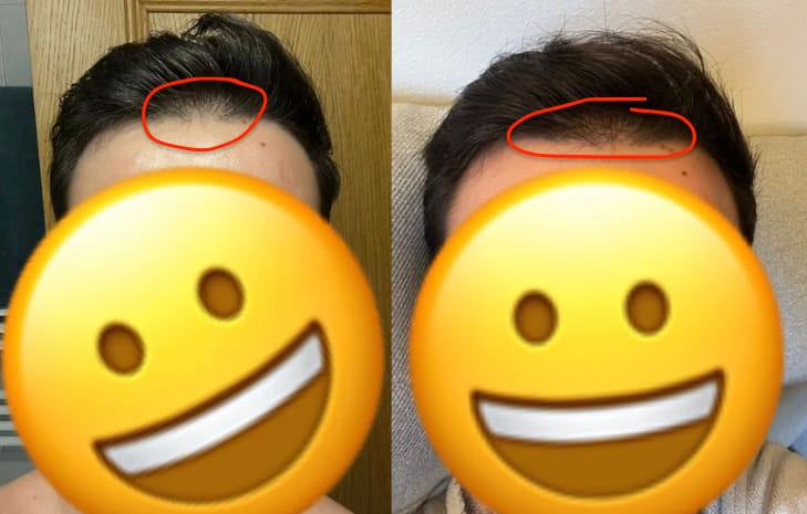 Customer photo review of Sérum Anticaída de Doble Acción | Hair Biolabs™