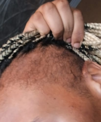 Customer photo review of Minoxidil REGULAR (2%) strength SOLUTION, 3x60ml pack