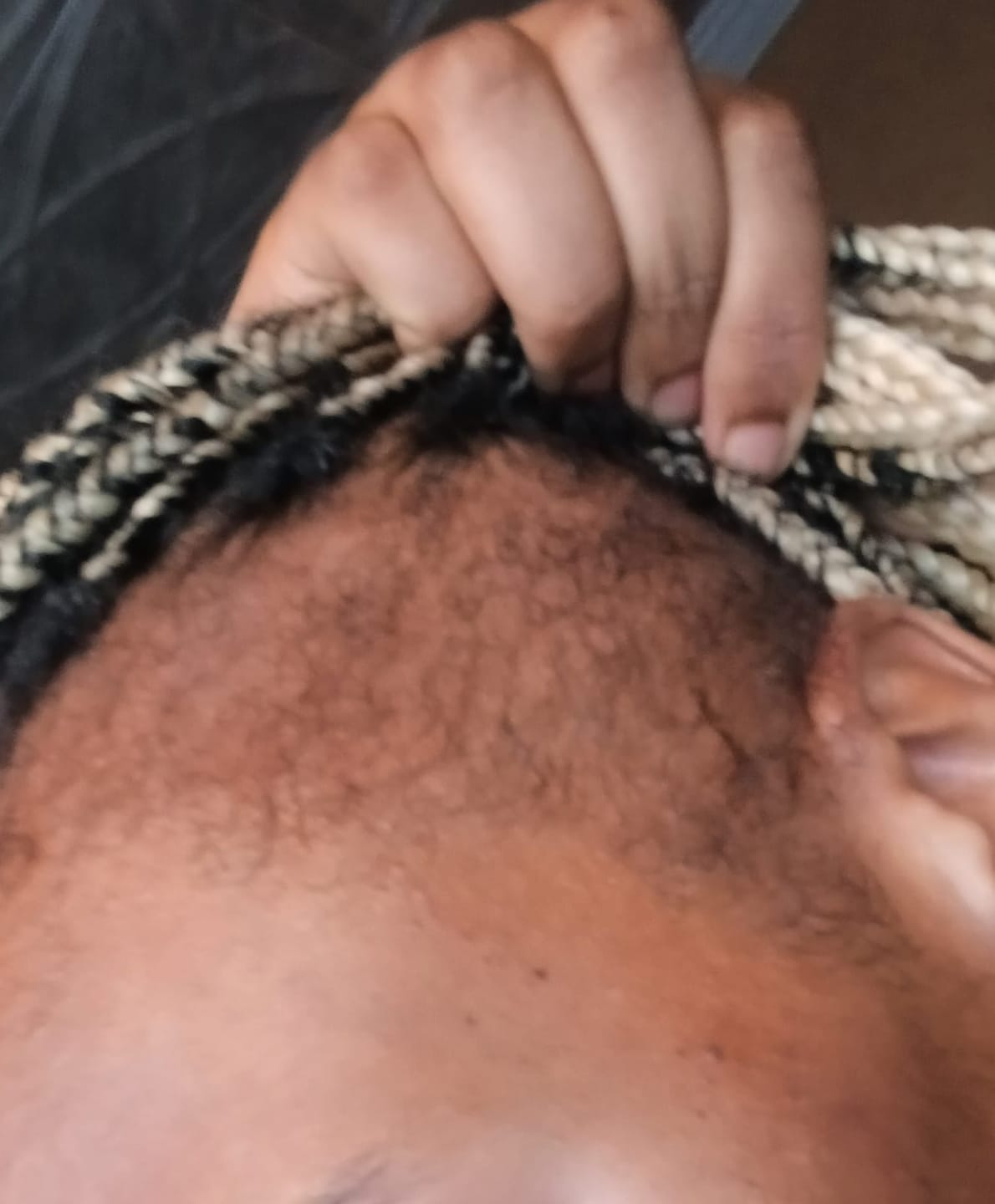 Customer photo review of Minoxidil REGULAR (2%) strength SOLUTION, 3x60ml pack