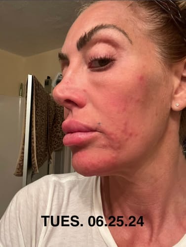 Customer photo review of JOVS 4D Laser Light Therapy Mask