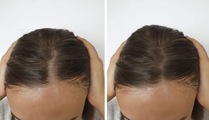 Customer photo review of Hair Biolabs REDENSIFY™ Sérum de Triple Acción- Para la Caida en 14 dias