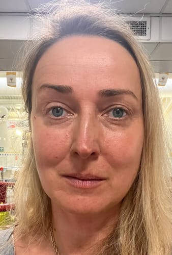 Reviewer's face after applying Rosalique 3 in 1 Anti-Redness Miracle Formula, showing a more even and less red skin tone.