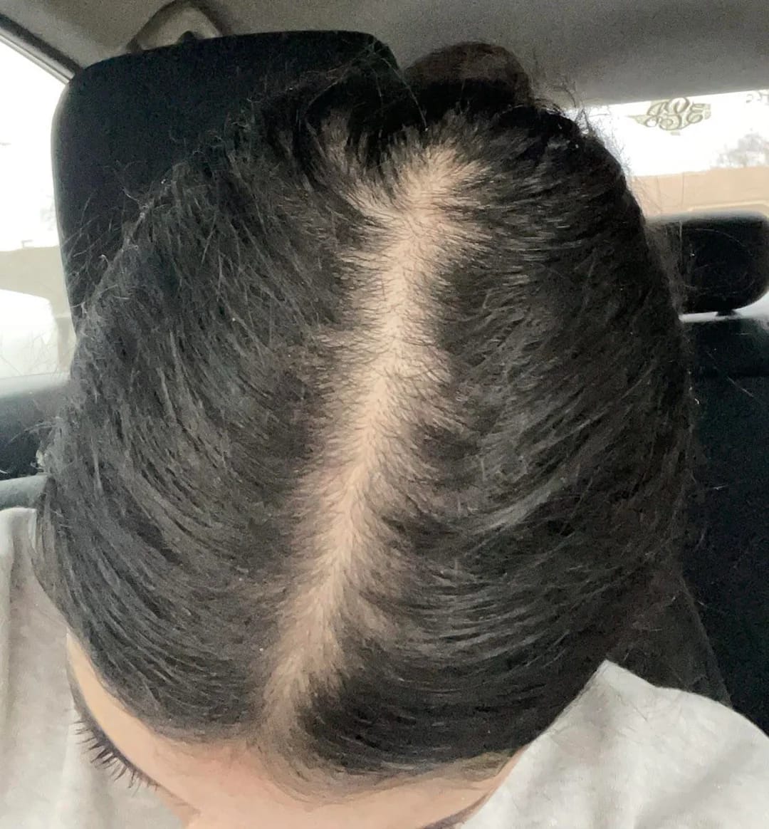 Customer photo review of Hair Biolabs REDENSIFY™ Sérum de Triple Acción- Para la Caida en 14 dias