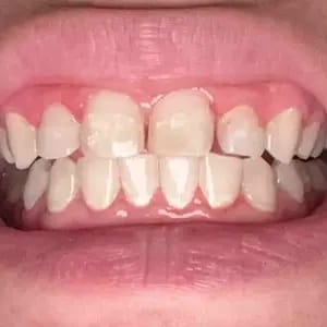 Customer photo review of Viralaluna™ Purple Teeth Whitening Strips