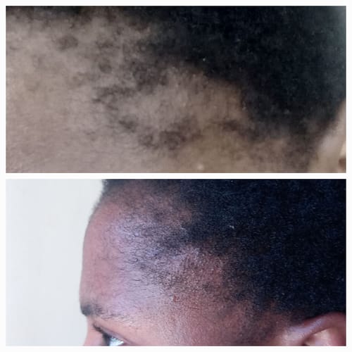 Customer photo review of Minoxidil High Strength (5%) SOLUTION, 3x60ml pack