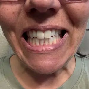 Customer photo review of Viralaluna™ Purple Teeth Whitening Strips