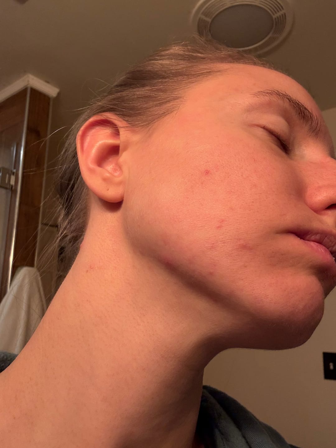 Customer photo review of Kill Acne & Redness Ritual