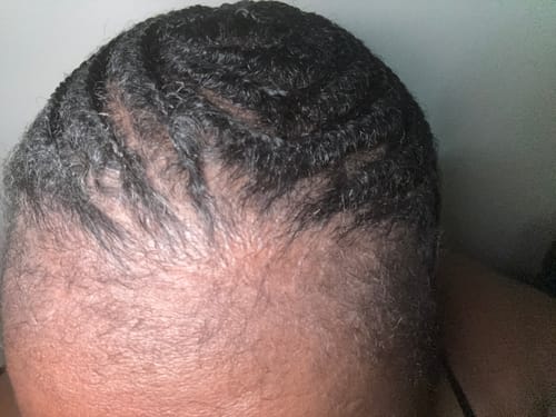 Customer photo review of Minoxidil High Strength (5%) SOLUTION, 3x60ml pack