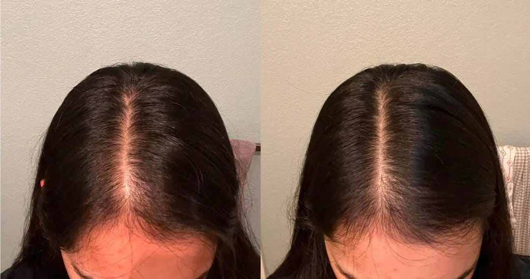 Customer photo review of Hair Biolabs REDENSIFY™ Sérum de Triple Acción- Para la Caida en 14 dias