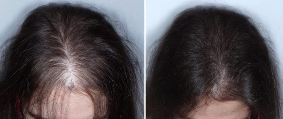Customer photo review of Hair Biolabs REDENSIFY™ Sérum de Triple Acción- Para la Caida en 14 dias