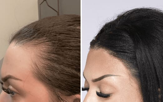 Customer photo review of Hair Biolabs REDENSIFY™ Sérum de Triple Acción- Para la Caida en 14 dias