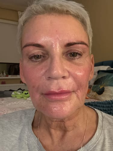 Customer photo review of DIVAYA™ - Kit Micro-Infusion Anti-Âge