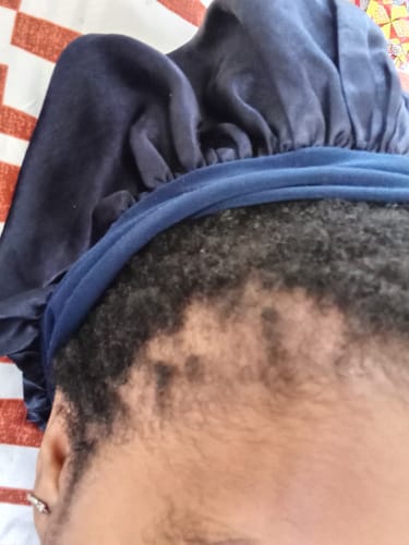 Customer photo review of Minoxidil 5% Solution, 1 Pack 60ml