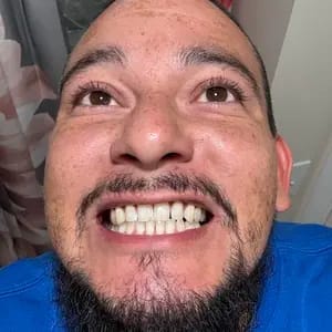 Customer photo review of Viralaluna™ Purple Teeth Whitening Strips